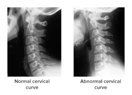 Cervical Spine Curve